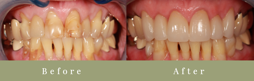 before and after teeth