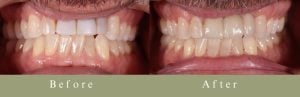 tooth comparison with before and after images